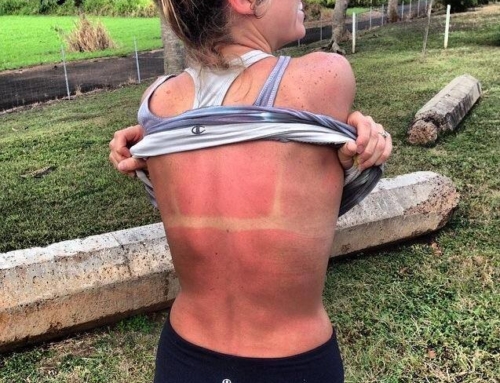 SOME OF THE LEAST EXPECTED WAYS TO GET A SUNBURN